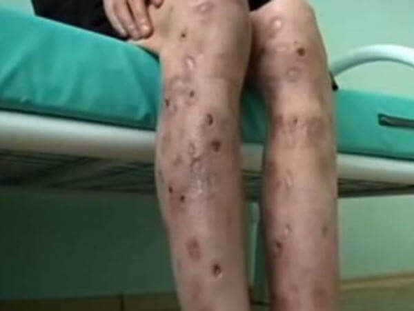 Krokodil: ¿La droga Zombie?