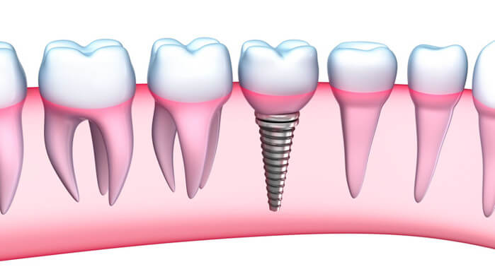 fotos de implantología dental